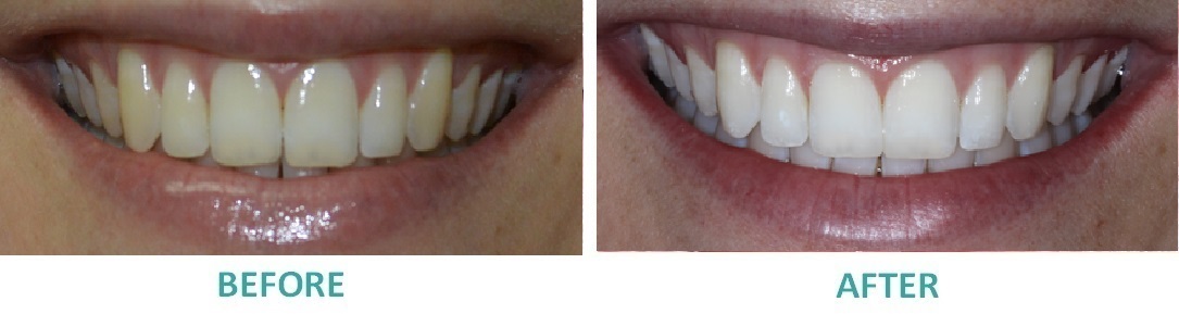 Teeth Whitening Geelong